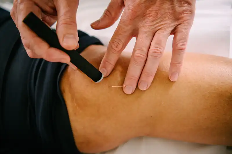 Hand held moxibustion stick being used next to an acupuncture needle