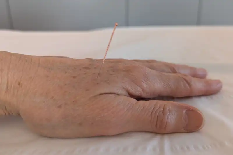 a hand with an acupuncture needle in it